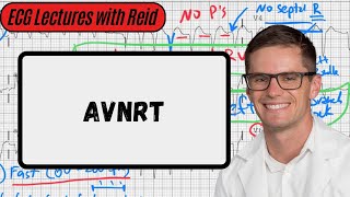 AV Nodal Reentry Tachycardia  Day 16 ECG Challenge [upl. by Tully744]