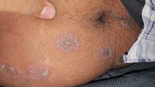 Ringworm Infestation Tinea ringworm fungal imwell [upl. by Esila]