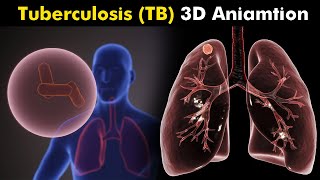 Tuberculosis  causes symptoms diagnosis treatment pathology [upl. by Artina171]