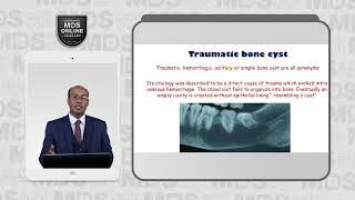 11 2 Traumatic bone cyst [upl. by Swihart]