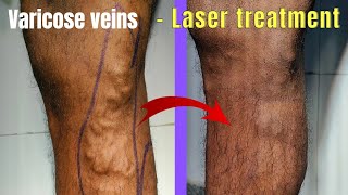 Combination treatment of varicose veins  Laser  Foam Sclerotherapy Laser treatment of varicose [upl. by Anrat]