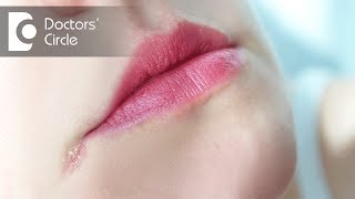 How to manage Angular Cheilitis  Dr Aniruddha KB [upl. by Jaquenette]