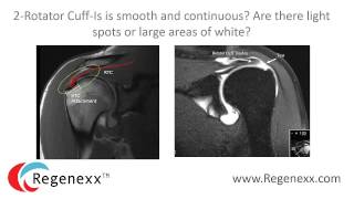 How to read your shoulder MRI with Dr Centeno of Regenexx [upl. by Rawlinson]