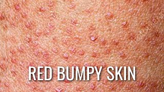 Keratosis Pilaris  How To Get Rid of Chicken Skin [upl. by Quinby]