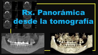 Rx panorámica desde la tomografía [upl. by Winnie]