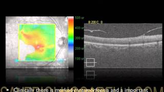 OCT IN EPIRETINAL DISEASE LE MEMBRANE EPIRETINICHE STUDIATE CON OCT MACULARE [upl. by Libnah227]