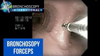 Flexible Bronchoscopy Basic Techniques for Forceps Biopsy [upl. by Malchus863]