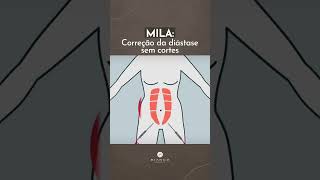 Abdominoplastia sem cortes MILA [upl. by Acinnej]