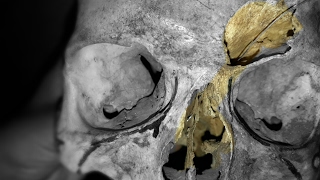 Frontal sinus communicating Nasal Cavity  Frontonasal Duct [upl. by Acus]