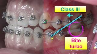 Class III Molar Protraction｜CC418 [upl. by Arni]