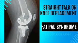 Straight Talk on Knee Replacement  Fat Pad Syndrome [upl. by Mafalda]