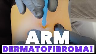 ARM DERMATOFIBROMA [upl. by Oah]