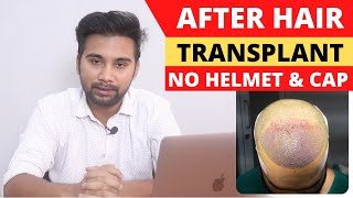 Why Cant We Use Helmets and Cap After Hair Transplant  Precautions After Hair Transplant [upl. by Alake]