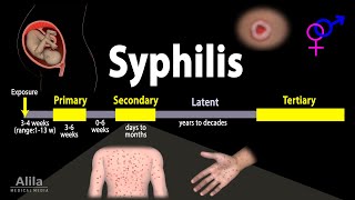 Syphilis  Pathophysiology Diagnosis and Treatments Animation [upl. by Blumenthal400]