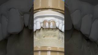 Central Amber Press Crowns lsk121shorts dentistry teeth [upl. by Rebhun]