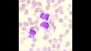 NPM1 mutated Acute Myeloid Leukaemia [upl. by Yleme66]