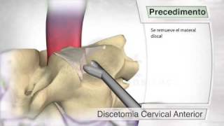 Disectomía cervical anterior [upl. by Reinertson451]