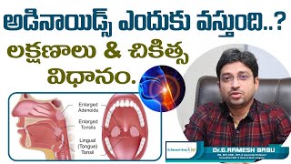 అడినాయిడ్స్ ఎందుకు వస్తుంది  Adenoids or Adenoid Hypertrophy Treatment  Dr Ramesh Babu ENT [upl. by Adnirem886]