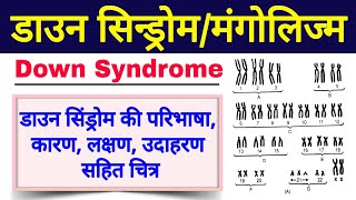 डाउन सिंड्रोम क्या है  down syndrome in hindi class 12 biology  down syndrome ke lakshan Mongolism [upl. by Lovel]