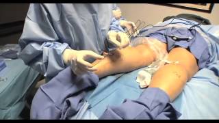 Varicose Vein Ablation  UCLA Vital Signs [upl. by Biles203]