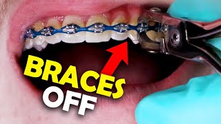 Braces Removal A StepbyStep Guide by an Orthodontist [upl. by Ytsirt]