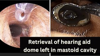 Video showcasing the removal of a hearing aid dome from the mastoid cavity [upl. by Eilyr]