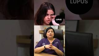 Selena Gomez Revealed Suffering From Lupus  What is Lupus By Dr Nivedita Dadu  youtubeshorts [upl. by Sillig]