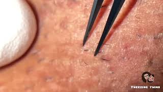 Ingrown Hair Removal ep25 [upl. by Jaquelin]