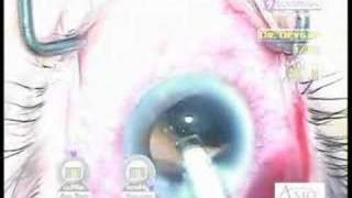 cataract surgery glaucoma tube shunt by Uday Devgan MD [upl. by Anaul]