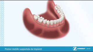 protesi mobile supportata da impianti dentali  a cura di CMO wwwcmosrlnet [upl. by Alyss707]