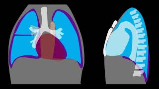 Pneumothorax Explained by Prometheus Lionhart MD [upl. by Arikaahs]