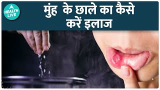 Mouth Ulcer  Causes and Cure  Effective Home Remedies For Mouth Ulcers  Health Live [upl. by Rudd]