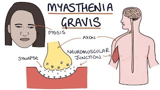 Myasthenia Gravis [upl. by Gierc922]