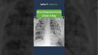 Understanding Bronchopneumonia 🫁 MedicalEducation usmle [upl. by Barcot]