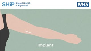 Having a contraceptive implant fitted [upl. by Crispas531]