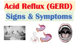 Gastroesophageal Reflux Disease GERD Signs amp Symptoms ex Bad Teeth  amp Why They Occur [upl. by Florie]