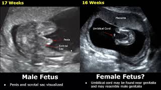 Fetal Gender Determination On Ultrasound  Determining The Sex Of A Baby On USG BoyGirl [upl. by Eybbob]