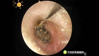 Ear wax removalFungus cleaning Ear canal cleaningEndoscopic Ear Treatment（外耳道清理，真菌感染清理）20230813 [upl. by Brant]