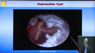 ETV and endoscopic intraventricular cyst management [upl. by Fee]