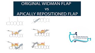 ORIGINAL WIDMAN FLAP vs APICALLY REPOSITIONED FLAP PERIODONTAL FLAP SURGERY DR ANKITA KOTECHA [upl. by Netaf]