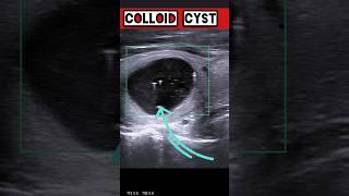 Colloid Cyst of Thyroid Gland 🩺 medical health thyroid ultrasound viral [upl. by Amandie]