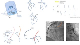 Grafts engagement femoralradial detailed steps diagrams troubleshooting and videos SVGLIMA [upl. by Eggleston200]