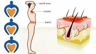 Shingles  The causes symptoms treatment and prevention [upl. by Sutelc]