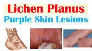 Lichen Planus “Purple Skin Lesions”  Causes Signs amp Symptoms Diagnosis Treatment [upl. by Ard233]