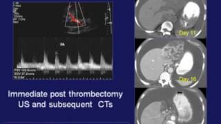 RouxenY hepaticojejunostomy technique [upl. by Annahael]