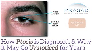 How Eyelid Ptosis is Defined by Measuring the Eyelids in Relation to the Iris and Pupil [upl. by Bunni]