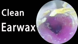 Ear picking tutorial Clean the earwax giants in the ears and relieve the painearpickearwax [upl. by Analed49]