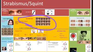 Ophthalmology 352 Strabismus Squint Difference Heterotropia Heterophoria define classification types [upl. by Agnola]