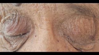 Ptosis causing Functional Blindness [upl. by Notgnirra]