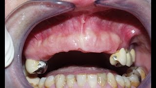 Implantes Dentales T5 [upl. by Aikaz296]